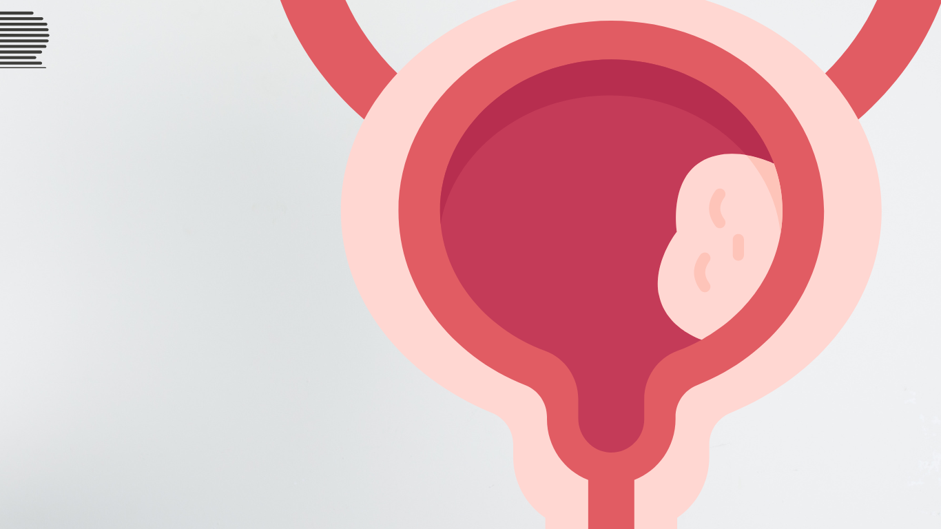 Conscientização e prevenção do câncer de bexiga